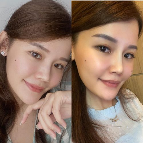 My Hiko Nose Thread Lift Review Before / After Photos Included